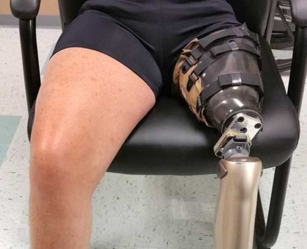 Above Knee