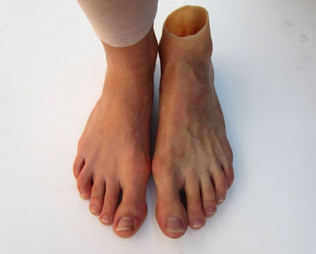 Partial Foot