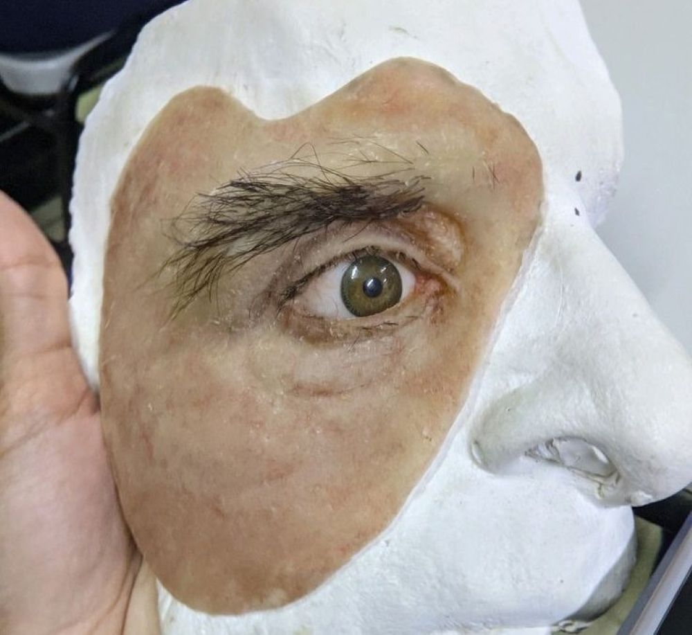 Maxillo Facial Prosthesis