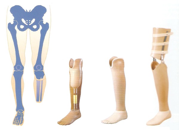 Lower Extremity Prosthetics – Matrix Mobility & Assistive Technologies